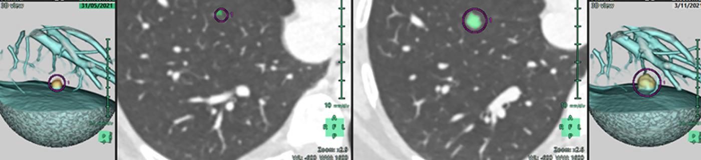 traiter le cancer pulmonaire synapse