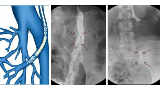 Embolisation par coil