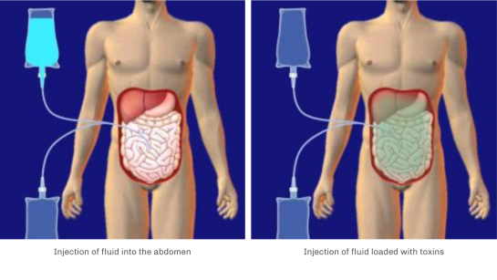 abords-pour-hemodialyse-catheter