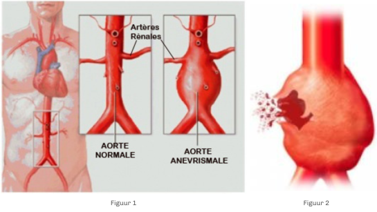 maladies-arterielles-anevrysmales
